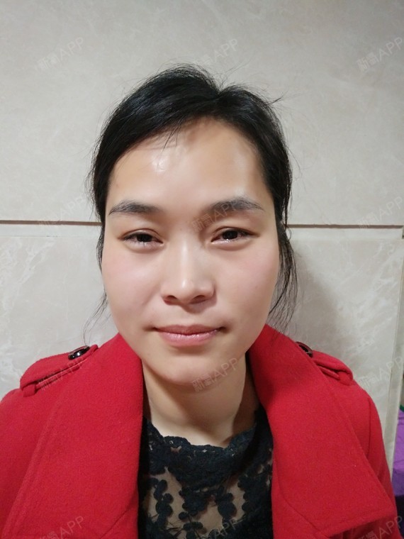 【祛眼袋 自体脂肪填充泪沟术后第113天】我是更新_圈子-新氧美容整形