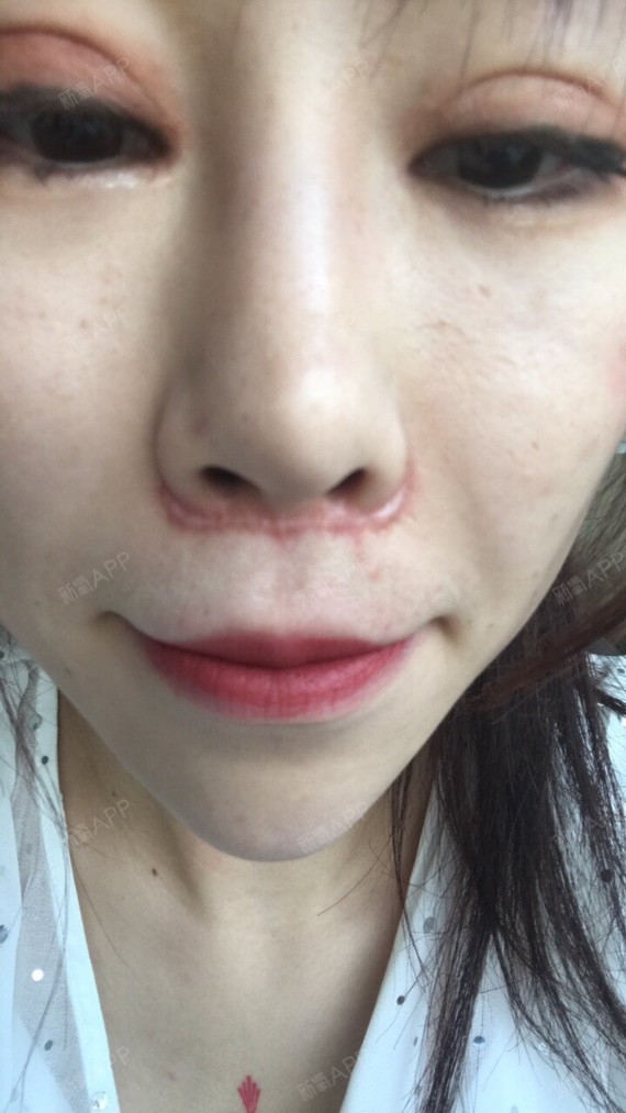 不要和我逃人中缩短术第62天美丽日记