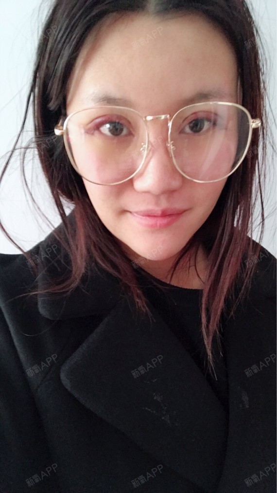 长春开内眼角好不好_效果图_张语嫣开内眼角术后第5天_新氧美容整形