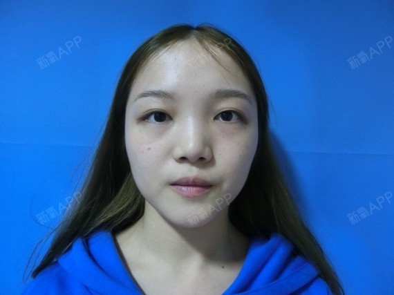 是不是所有的硅胶隆鼻都会出现鼻尖发红现象呢