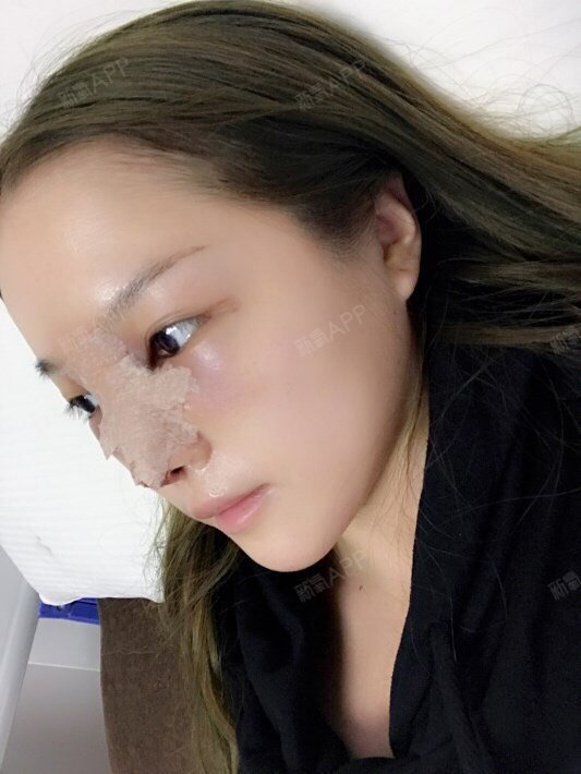 是不是所有的硅胶隆鼻都会出现鼻尖发红现象呢