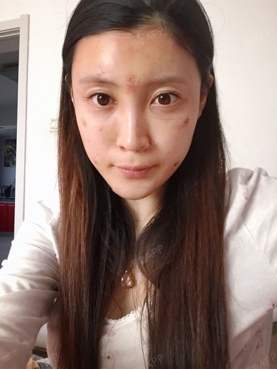 是谁抢我小熊自体脂肪全脸填充第1天美丽日记