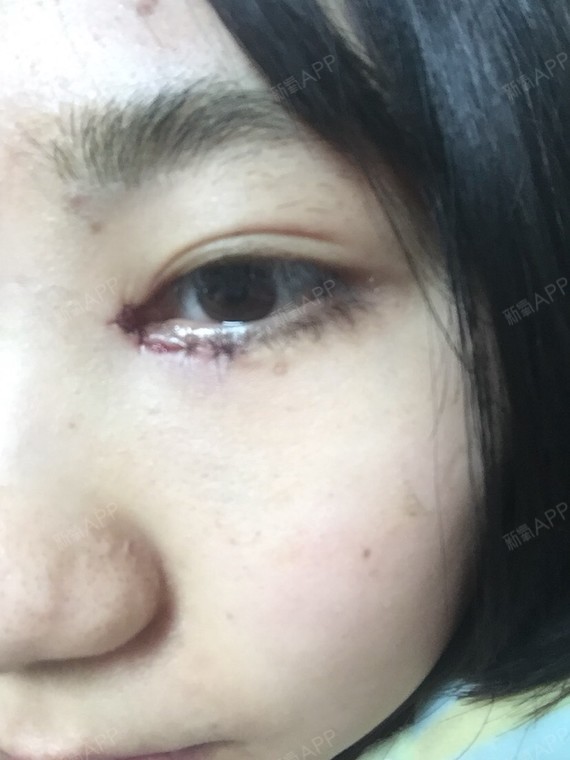通过新氧消费方案查看开内眼角手术中度疼痛眼形美化机构查看上海复旦