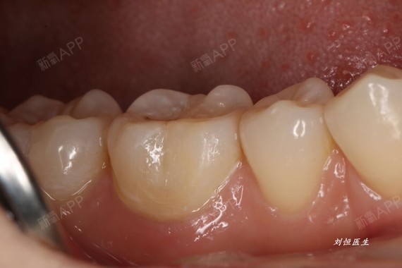 案例分享# 后牙6颊侧龋坏,去腐备洞,用树脂进行修复.