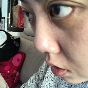 【下眼下至术】【下睑下至】0恢复期,无辜眼,猫眼,芭比眼,1周即可上妆