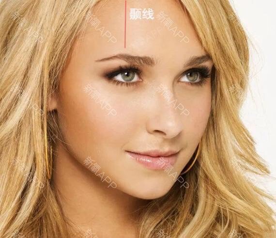 选择玻尿酸和自体脂肪丰额,填充过量会使额头部位额结节和颞线部位