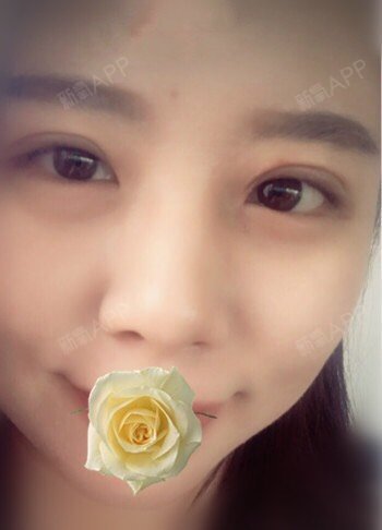 只开了双眼皮没有开眼角,现在还在恢复期,看看后期要不要开个