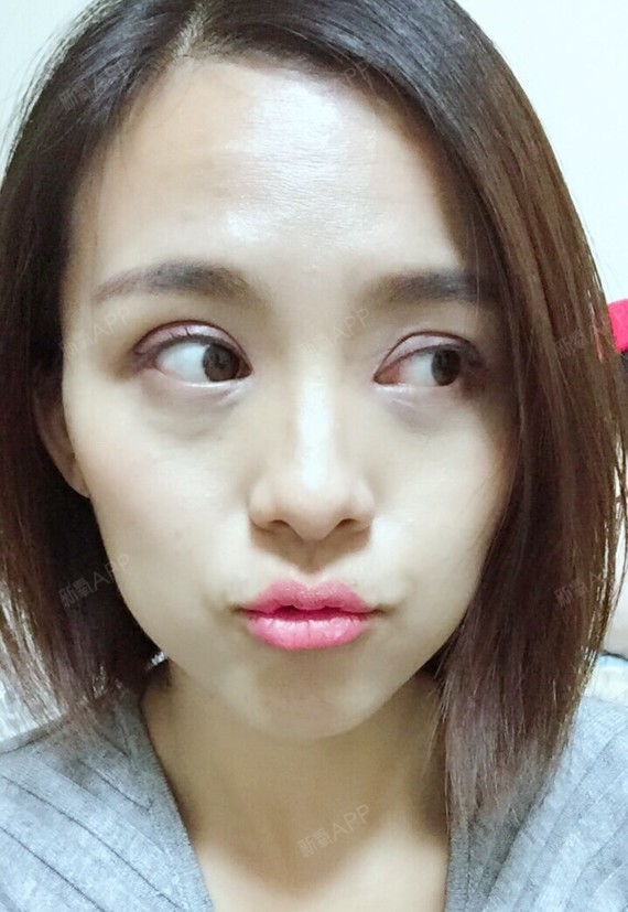 氧气cici开内眼角第72天美丽日记