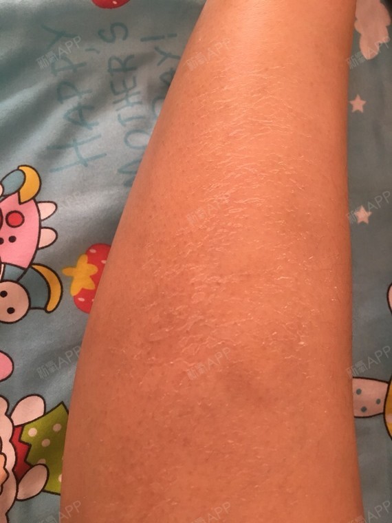 小腿开始脱皮了,据说是因为手术过程中消毒,所以皮肤干燥