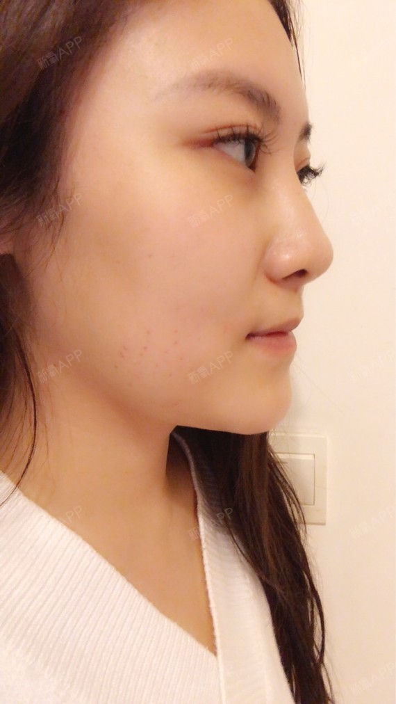 成都溶脂针瘦脸好不好_效果图_小氧氧溶脂针瘦脸术后第41天_新氧美容