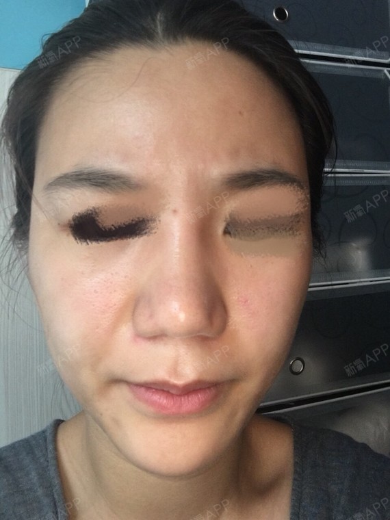 手术后造成鼻小柱内缩,鼻小柱疤痕增生,鼻头疤痕,鼻假体太宽晃动.