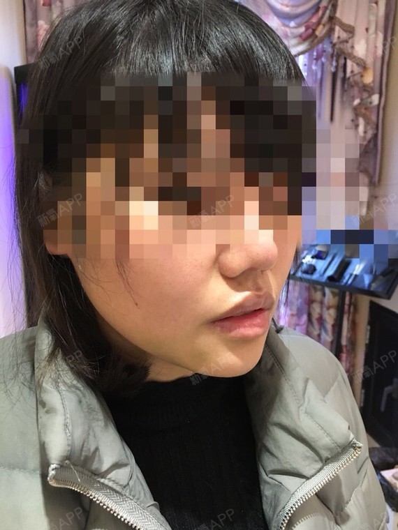 氧气0942211514257667 | 面部轮廓 | 硅胶垫下巴 | 术后当自强 | 失败