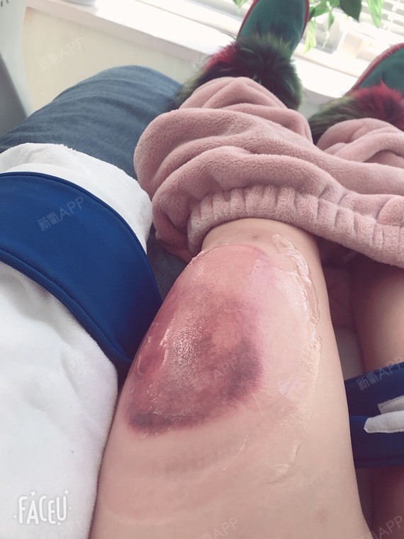 刚又做了冷冻大腿,万万没想到做会这么淤青