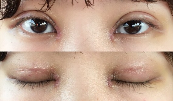 开内眼角好不好_效果图_仙女本仙开内眼角术后第8天_新氧美容整形