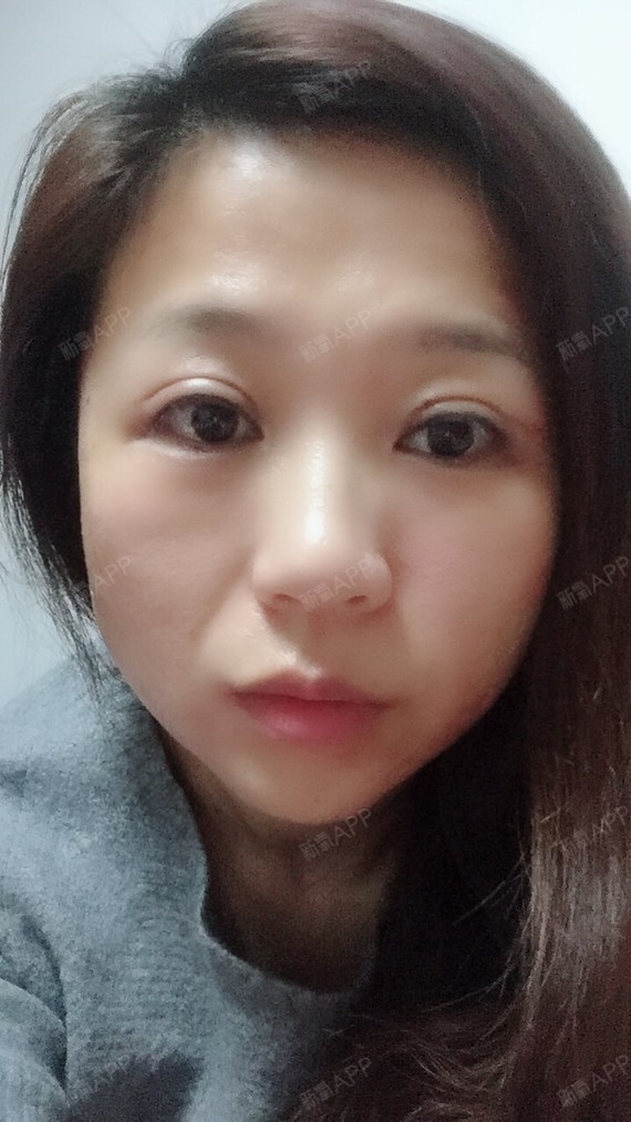 年2月16日 上海新健威医疗美容门诊部有限公司 双眼皮重睑术 眼尾提升