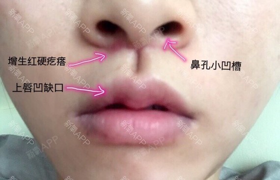 人中缩短术