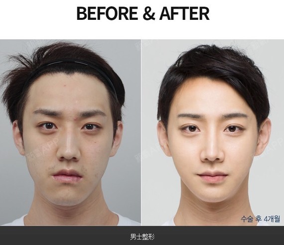 男士眼部整形-与女性不同的整形方案