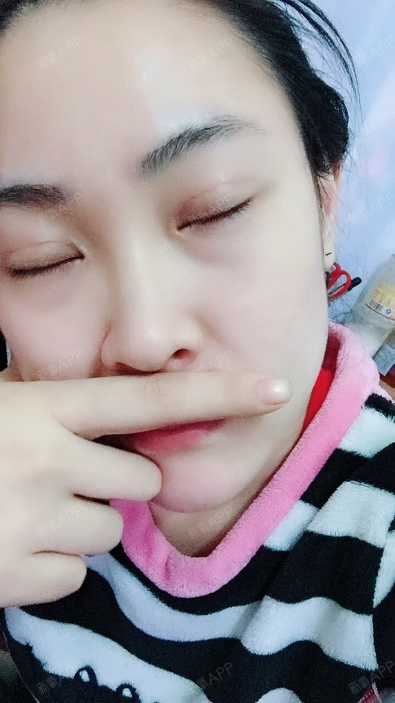 不知不觉已经过了二十天了,双眼皮当然还是肿肿鼓鼓的_圈子-新氧美容