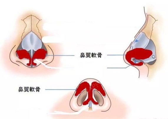 简单带大家看看鼻部的组成部分主要看鼻骨鼻中隔鼻翼软骨三个部分