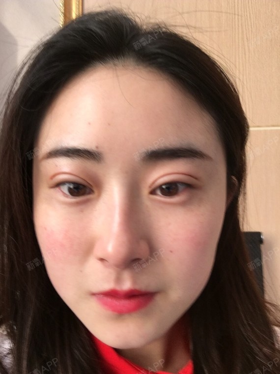 不开刀双眼皮还没有完全恢复,看起来还有点手术的痕迹_圈子-新氧美容