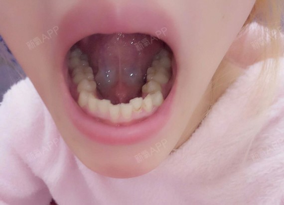 正常情况下,牙齿咬合时,上前牙是稍微覆盖住下前牙,如果上前牙切缘盖