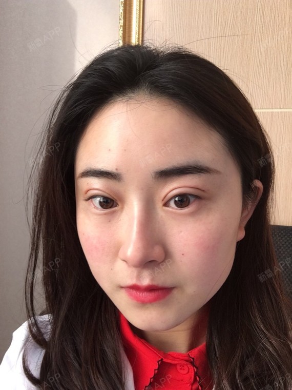 不开刀双眼皮还没有完全恢复,看起来还有点手术的痕迹_圈子-新氧美容