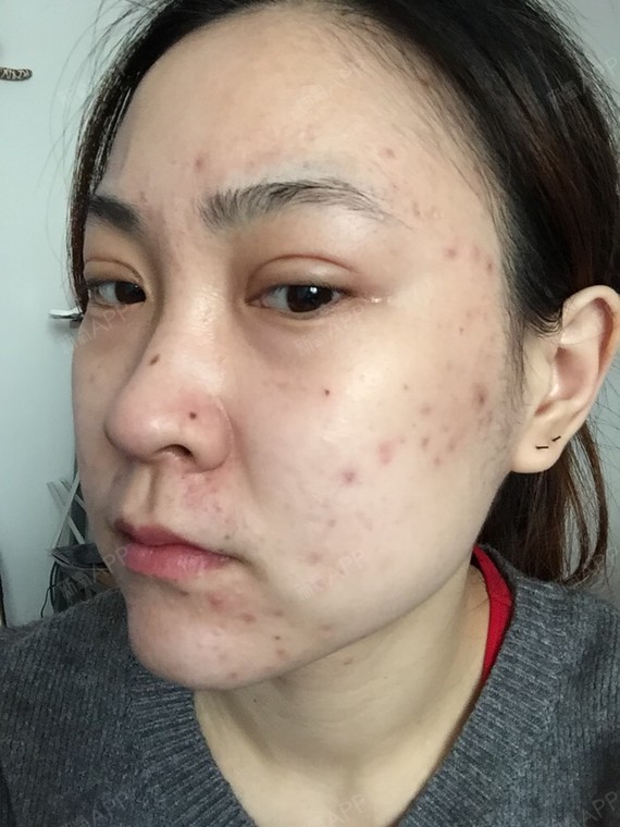 光子嫩肤第一天,以前都没有试过做这些,想来抱着试试_圈子-新氧美容