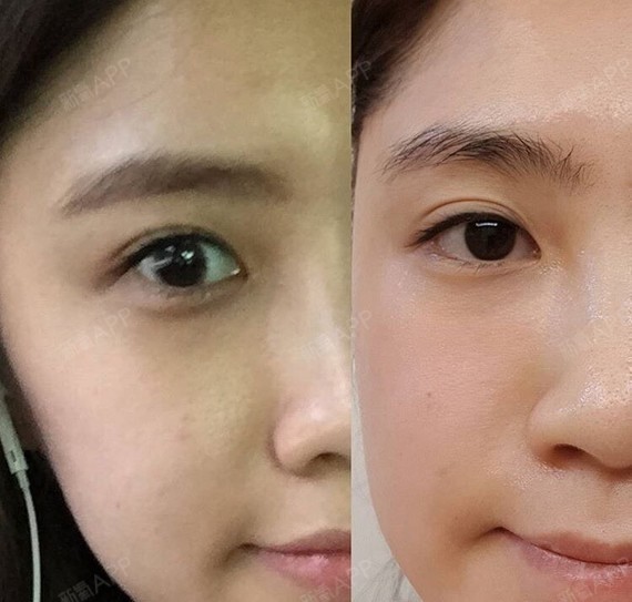 上海水光针好不好_效果图_严蓓蕾水光针术后第7天_新氧美容整形