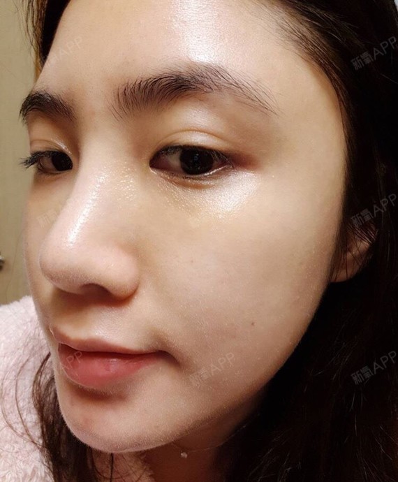 上海水光针好不好_效果图_严蓓蕾水光针术后第7天_新氧美容整形