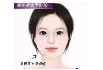 不是所有胖脸都适合打瘦脸针,咬肌肥大型大脸