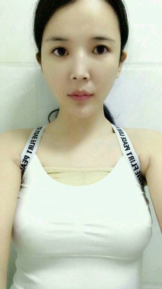 假体隆胸好不好_效果图_圆舞i假体隆胸术后第7天_新氧美容整形