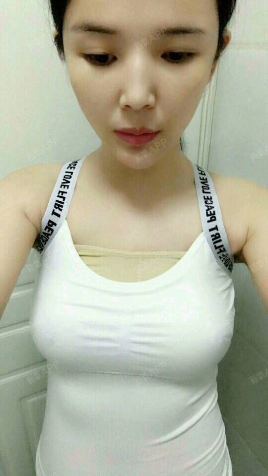 假体隆胸好不好_效果图_圆舞i假体隆胸术后第7天_新氧美容整形