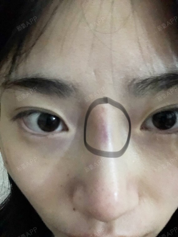 打的伊婉v打完了鼻子有点青是正常的么