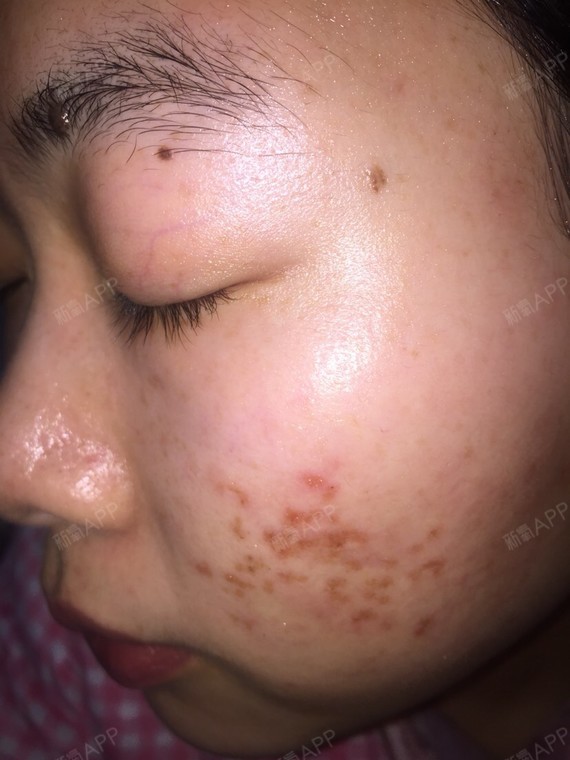 lydia_点阵激光第5天美丽日记