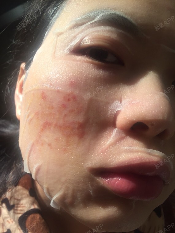 激光祛痘印恢复过程图点阵激光掉痂正常照片脸挠成菟丝做完点阵第二天