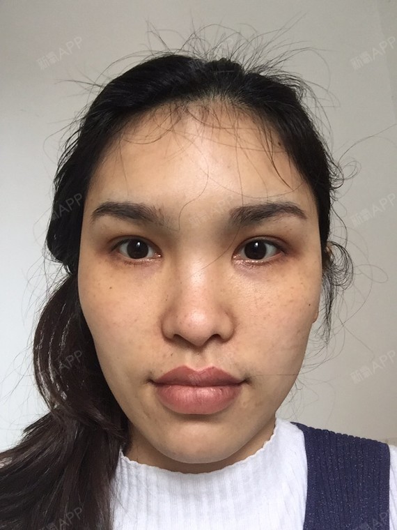 眼角开大了,不知道怎么办,真的一直折磨了半年,想修复又害怕