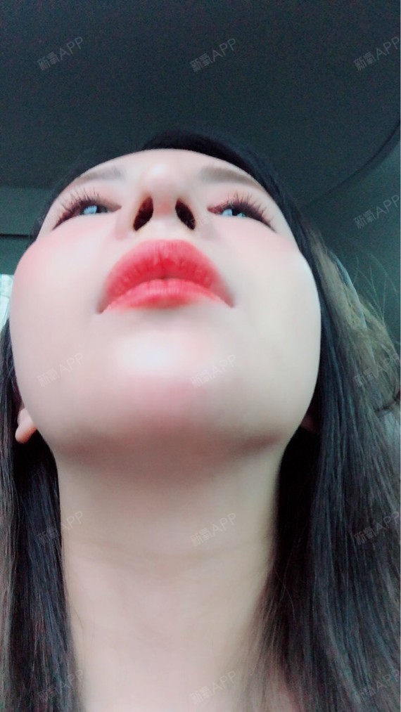 咿吖哟手术延长鼻小柱术后第29天美丽日记_新氧整形