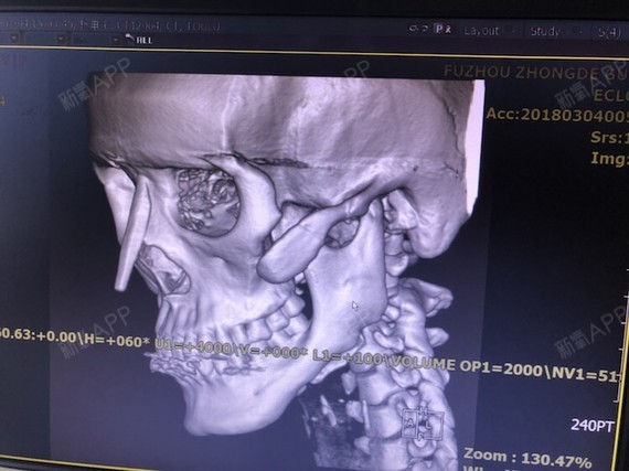 哪位医生帮我看看这个ct,看看如果不做修复的话,颧骨会怎么样