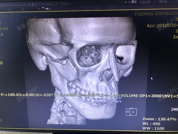 哪位医生帮我看看这个ct,看看如果不做修复的话,颧骨会怎么样