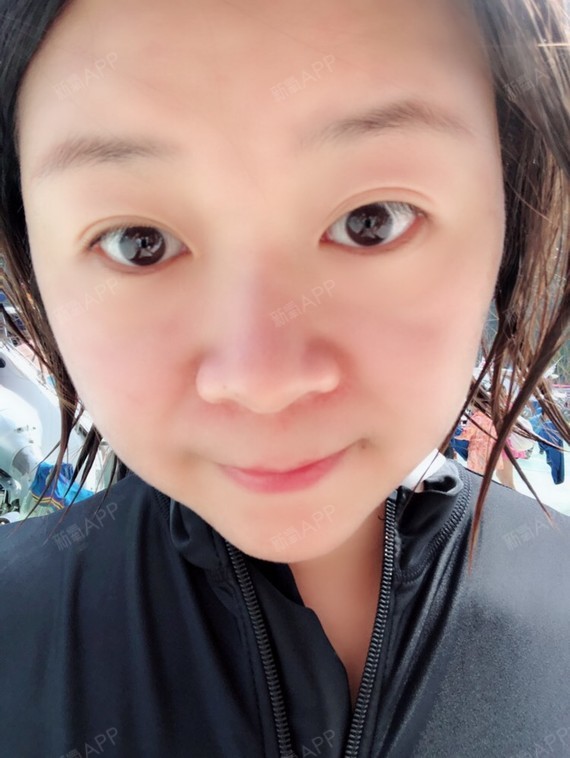 注射瘦脸好不好_效果图_氧气veceb6d注射瘦脸术后第80天_新氧美容整形