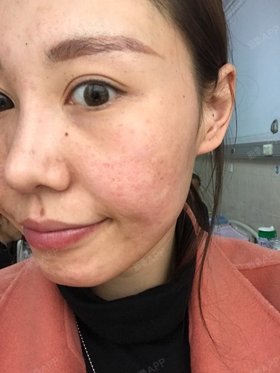 今天是打完水光针第5天.涂了水乳霜隔离的效果.
