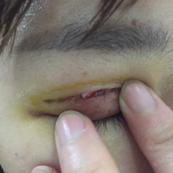 新氧- 哎哟哇 | 眼部 | 开眼角 | 双眼皮 | 开内眼角 | 切开双眼皮