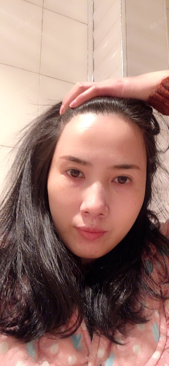 郑州脱发际线好不好_效果图_氧气77ld0cc脱发际线术后第0天_新氧美容