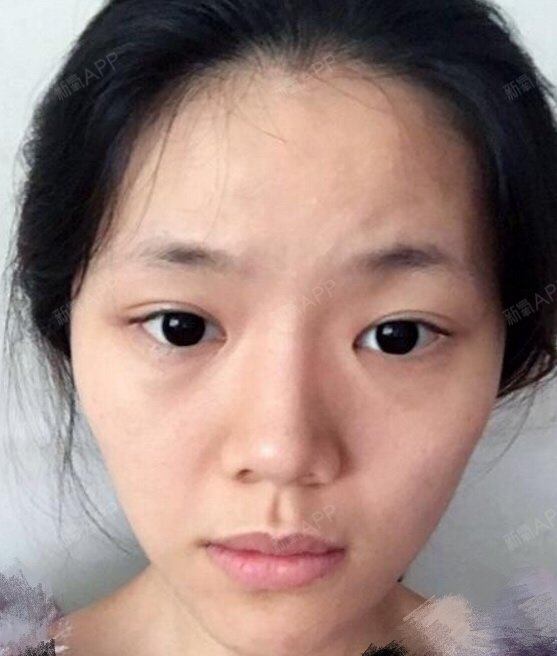 6767我是天生就很瘦的人,特别是脸部,看起来很干瘪,_圈子-新氧