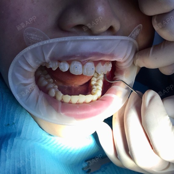 杭州隐形托槽矫正好不好_效果图_小叶子z隐形托槽矫正术后第0天_新氧