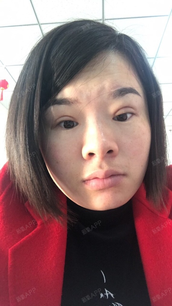 割双眼皮已经41天了,眼睛还肿的,好愁啊,本来还想整鼻子看来是