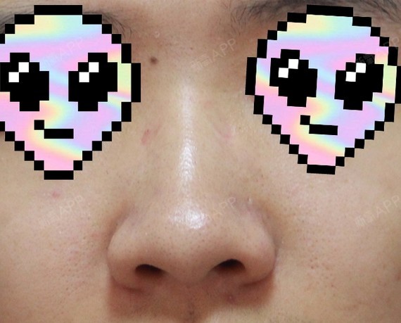 我有轻度的驼峰鼻,不知道你们看出来没,虽然不会大的_圈子-新氧美容