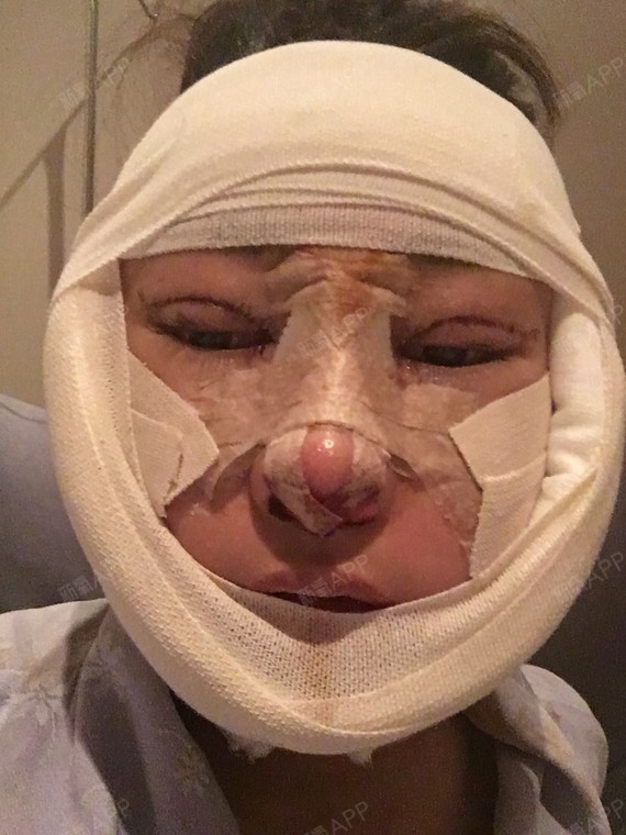 肿了 左半边脸l