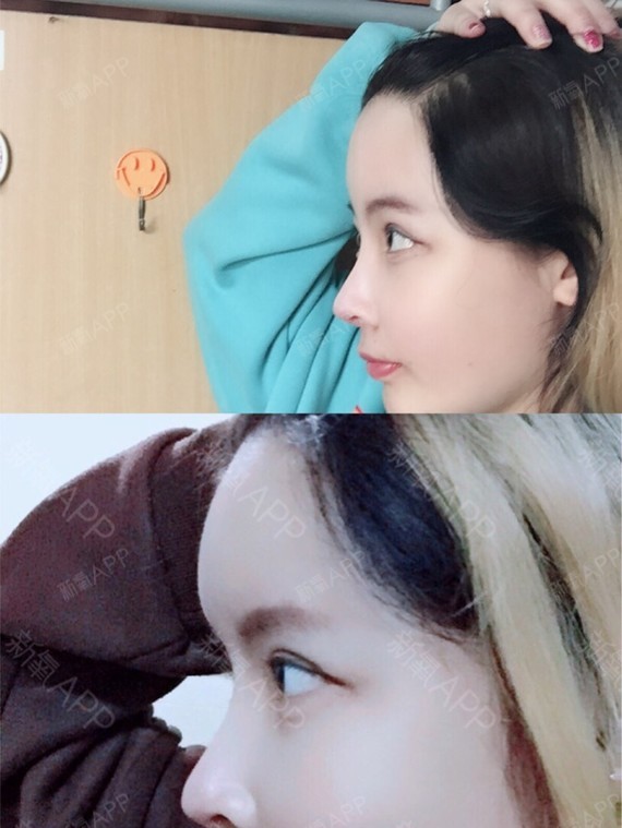 术后当自强 | 失败修复 | 南京同城 | 射频溶脂瘦脸 | 光纤溶脂瘦 