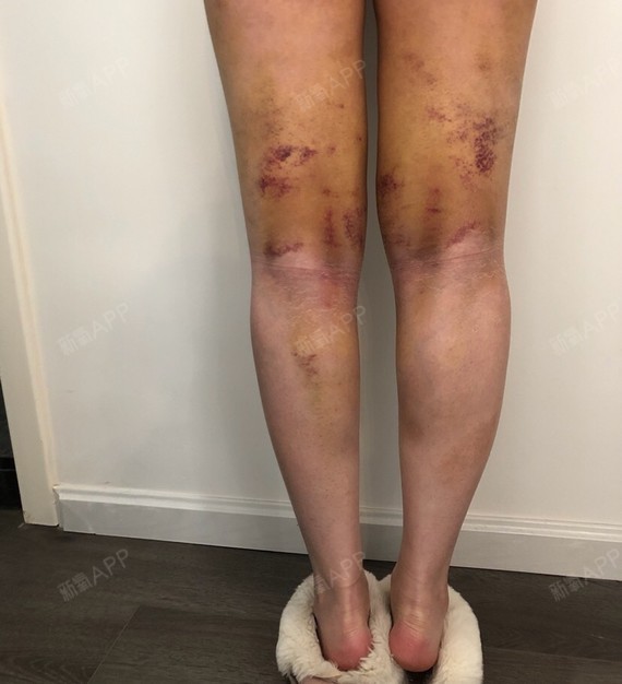 转眼做完瘦腿针已经半个月啦 吸脂瘦大腿也一个星期来,抱歉这几张照片